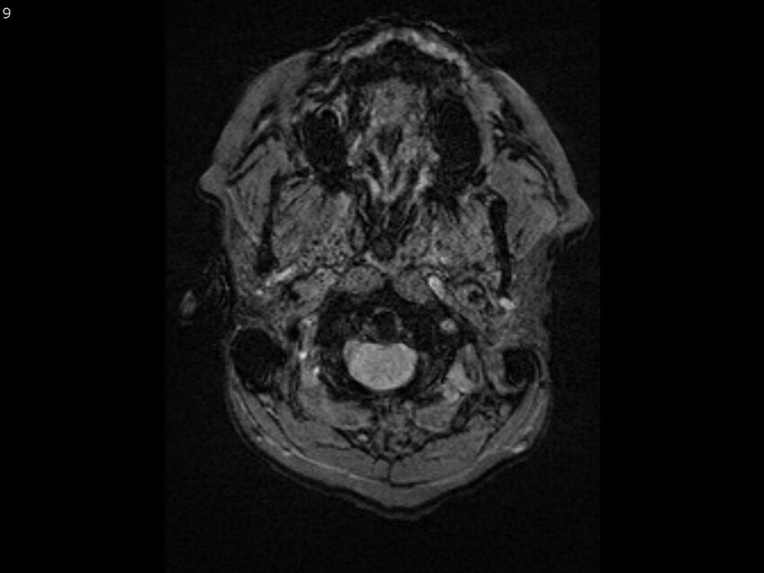 Atypical meningioma - intraosseous (Radiopaedia 64915-74572 Axial SWI 9).jpg