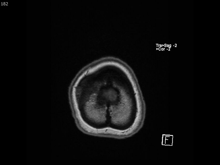Atypical meningioma - intraosseous (Radiopaedia 64915-74572 Axial T1 182).jpg