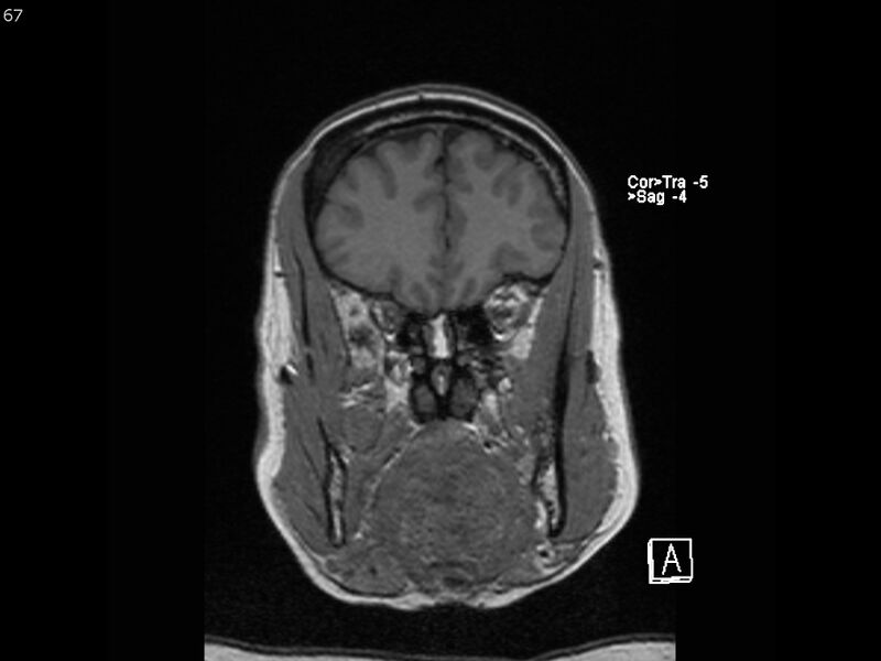 File:Atypical meningioma - intraosseous (Radiopaedia 64915-74572 Coronal T1 67).jpg