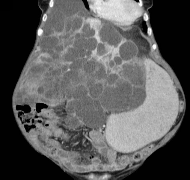 File:Autosomal dominant polycystic kidney disease (Radiopaedia 16777-16490 B 11).jpg