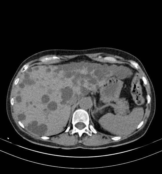 File:Autosomal dominant polycystic kidney disease (Radiopaedia 41918-44922 Axial non-contrast 5).jpg