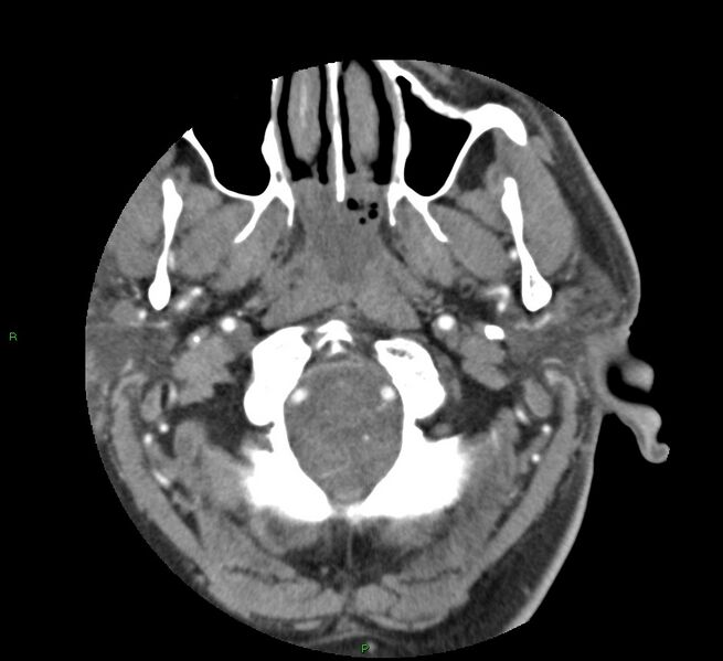 File:Basal ganglia hemorrhage (Radiopaedia 58763-65985 D 14).jpg