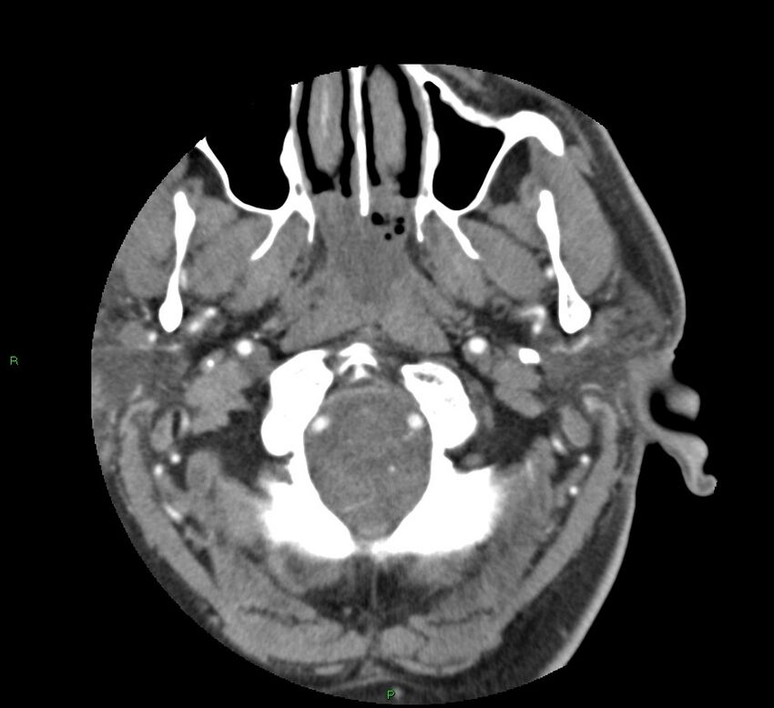 Basal ganglia hemorrhage (Radiopaedia 58763-65985 D 14).jpg