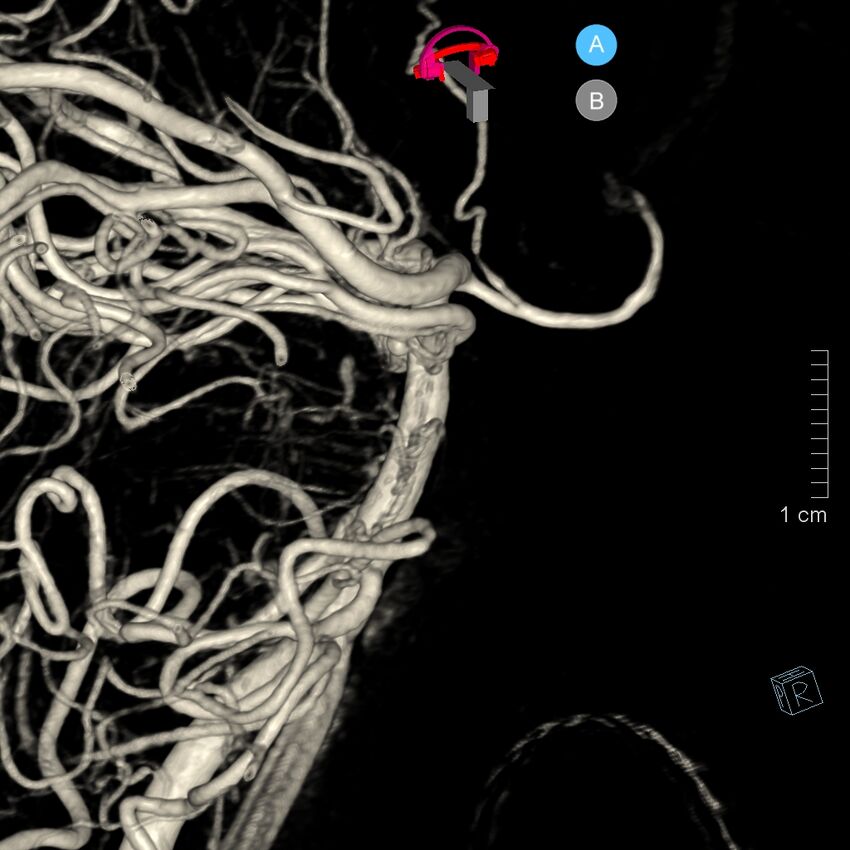 Basilar artery perforator aneurysm (Radiopaedia 82455-97734 3D view left VA 69).jpg