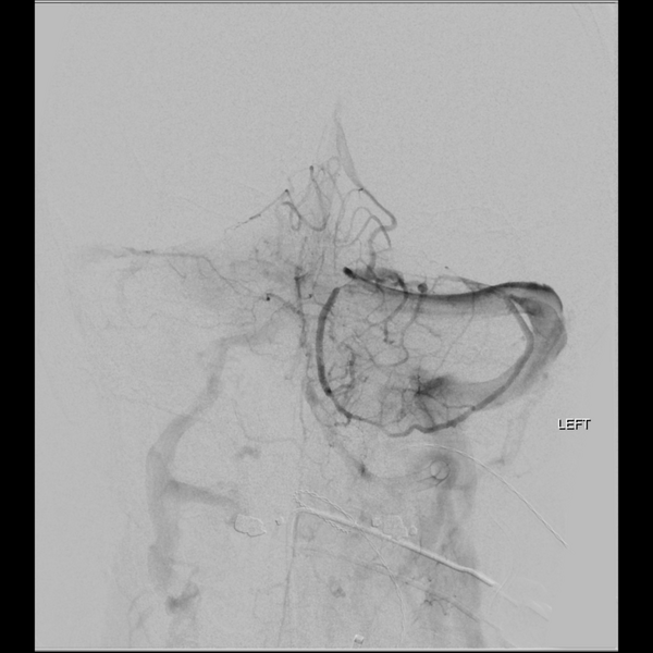 File:Basilar tip thrombus with endovascular clot retrieval (Radiopaedia 46320-50726 B 21).png