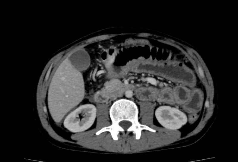 File:Behçet's disease- abdominal vasculitis (Radiopaedia 55955-62570 A 36).jpg