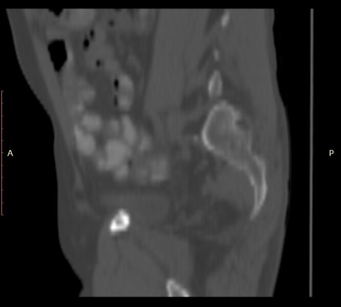 File:Bertolotti syndrome (Radiopaedia 58974-66235 Sagittal bone window 5).jpg