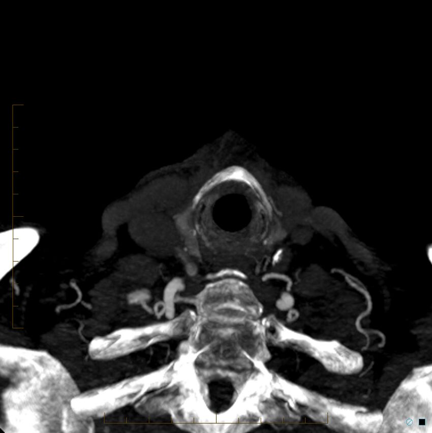 Bilateral chronic common carotid occlusion (Radiopaedia 50849-56362 D 48).jpg