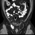 Bilateral direct inguinal herniae (Radiopaedia 17016-16719 A 8).jpg