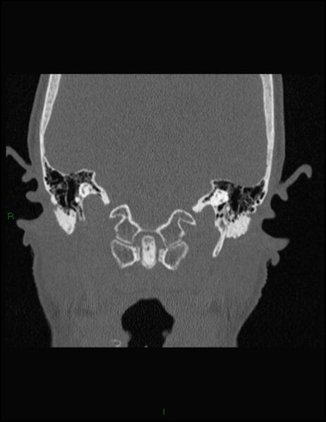 File:Bilateral frontal mucoceles (Radiopaedia 82352-96454 Coronal 323).jpg