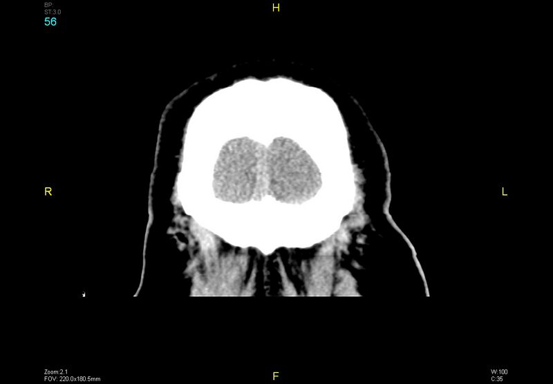 File:Bilateral medial medullary infarction (Radiopaedia 42220-45295 Coronal non-contrast 56).jpg