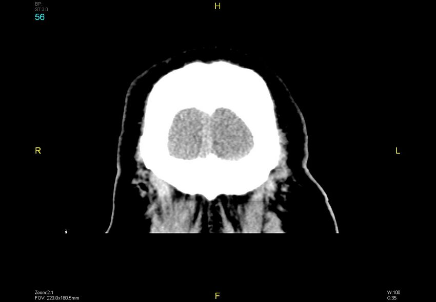 Bilateral medial medullary infarction (Radiopaedia 42220-45295 Coronal non-contrast 56).jpg