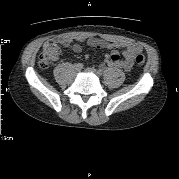 File:Bilateral medullary nephrocalcinosis with ureteric calculi (Radiopaedia 71269-81569 Axial non-contrast 88).jpg