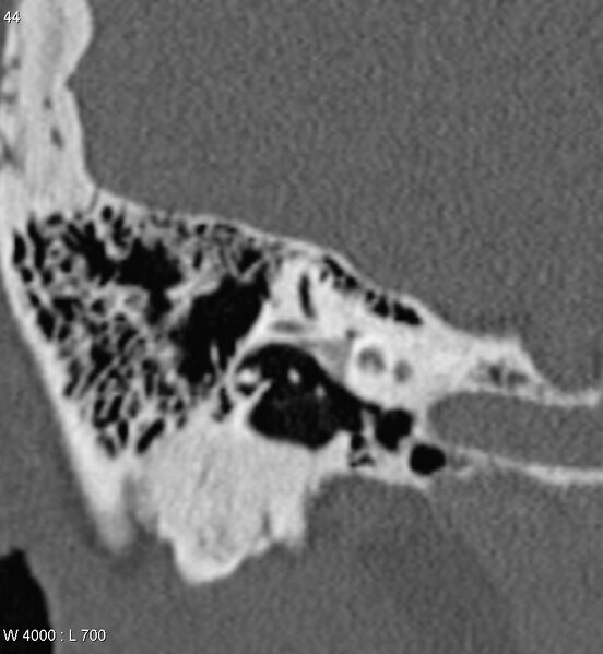 File:Bilateral otosclerosis with left stapes prosthesis (Radiopaedia 5567-7302 Coronal bone window 2).jpg