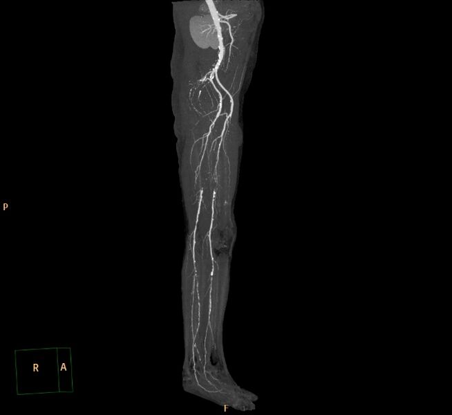 File:Bilateral superficial femoral arterial occlusion (Radiopaedia 25682-25857 3D MIP 6).jpg