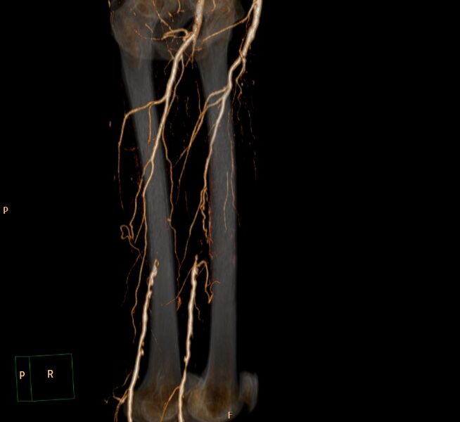 File:Bilateral superficial femoral arterial occlusion (Radiopaedia 25682-25857 3D VR 7).jpg