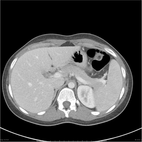 File:Bilateral ureteritis and cystitis (Radiopaedia 25340-25594 A 16).jpg
