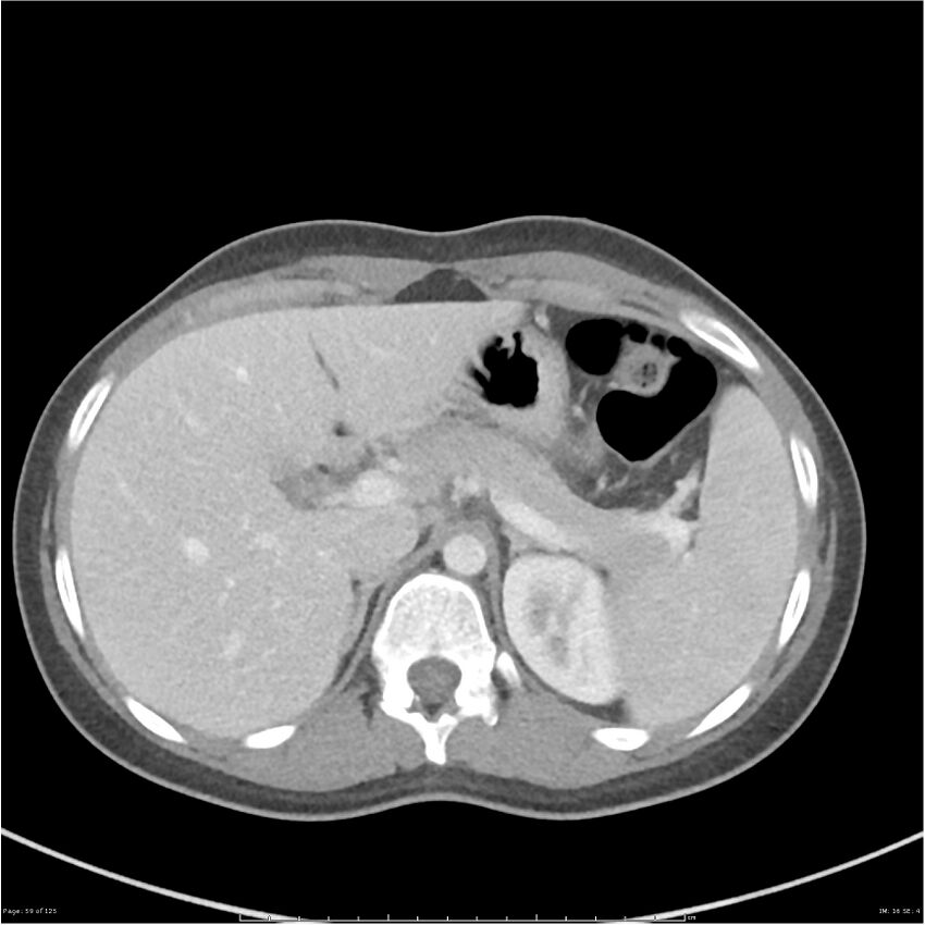 Bilateral ureteritis and cystitis (Radiopaedia 25340-25594 A 16).jpg