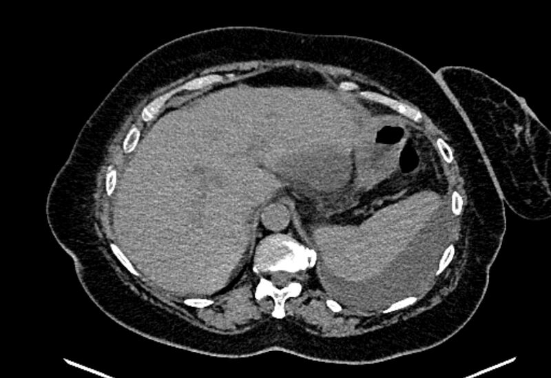 File:Biliary pancreatitis (Radiopaedia 72289-82823 Axial non-contrast 67).jpg