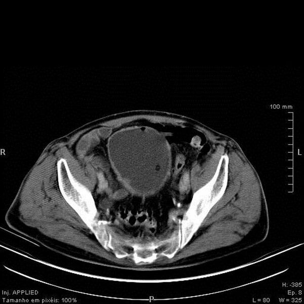 File:Bladder squamous cell carcinoma (Radiopaedia 14130-13984 B 5).jpg