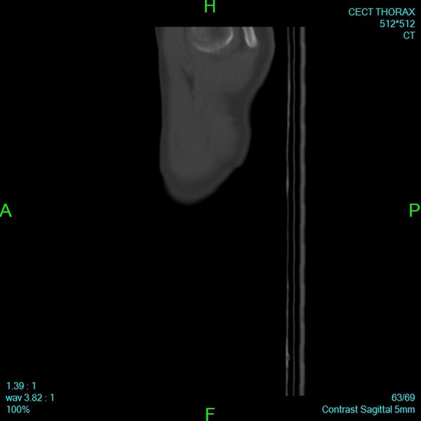 File:Bone metastases from lung carcinoma (Radiopaedia 54703-60937 Sagittal bone window 63).jpg