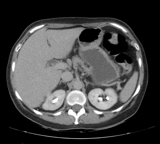 File:Bosniak renal cyst - type IV (Radiopaedia 22929-22953 D 16).jpg