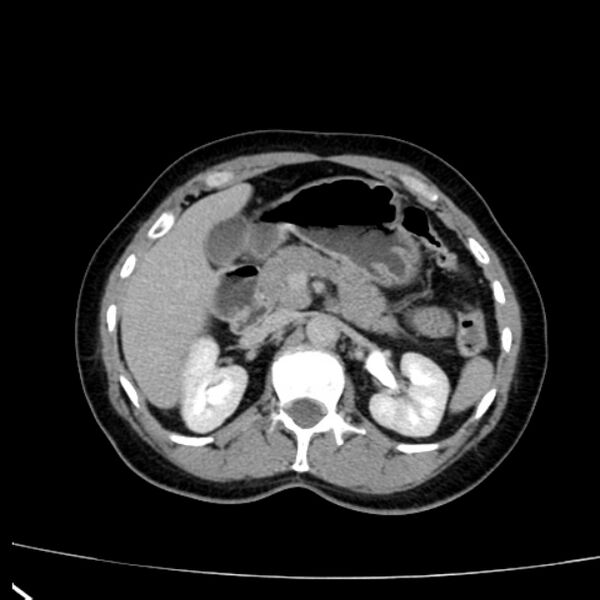 File:Bosniak renal cyst - type I (Radiopaedia 27479-27675 D 12).jpg