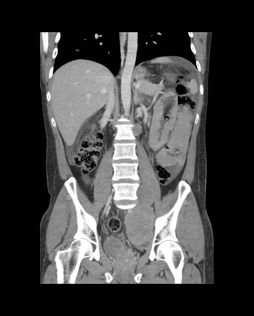 Bowel lymphoma complicated by bleeding after therapy (Radiopaedia 55601-62107 B 41).jpg