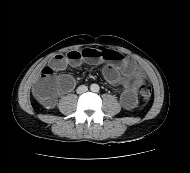 File:Bowel obstruction from colon carcinoma (Radiopaedia 22995-23028 A 49).jpg