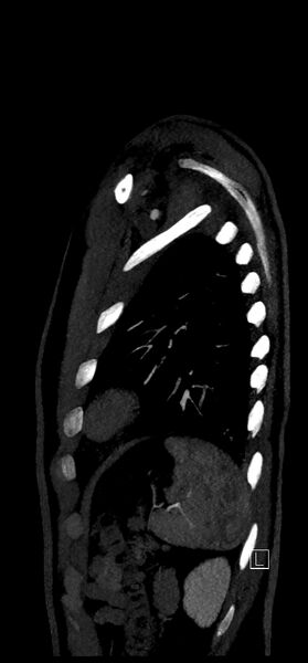 File:Brachiocephalic trunk pseudoaneurysm (Radiopaedia 70978-81191 C 78).jpg