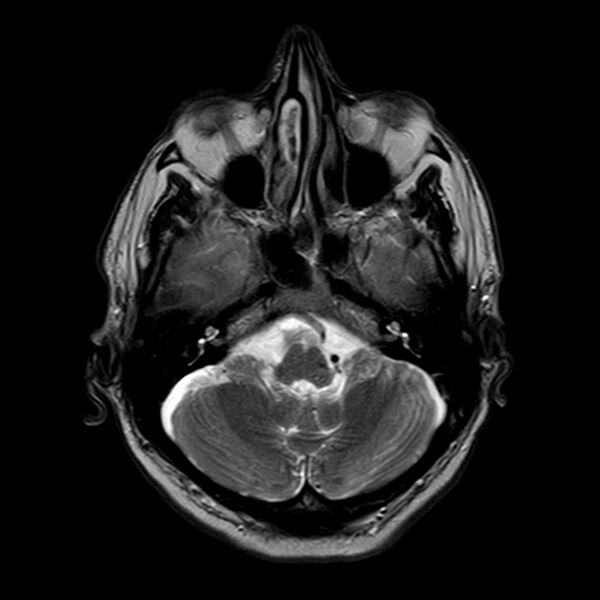 File:Brain abscess complicated by intraventricular rupture and ventriculitis (Radiopaedia 82434-96577 Axial T2 4).jpg