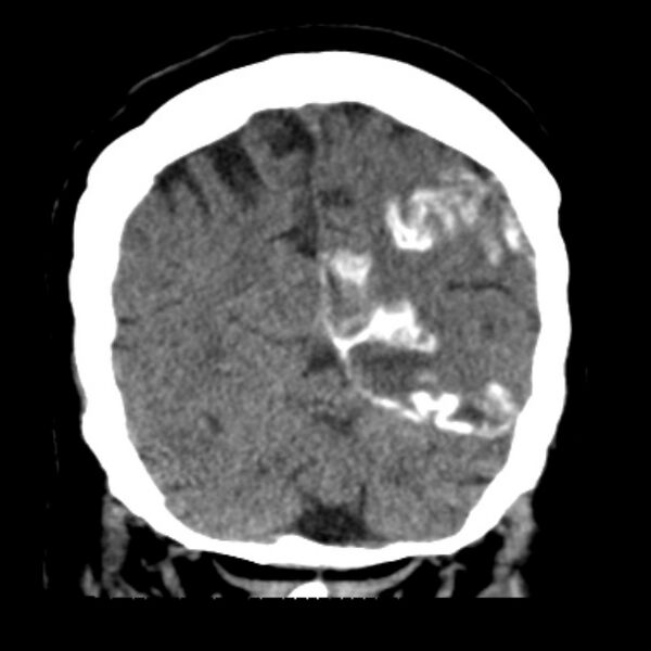 File:Brain cortical laminar necrosis (Radiopaedia 25822-25971 C 43).jpg