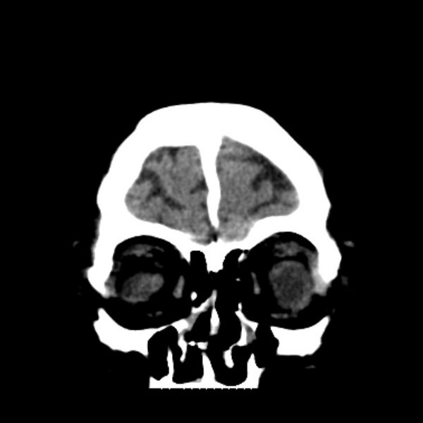 File:Brain cortical laminar necrosis (Radiopaedia 25822-25971 C 8).jpg