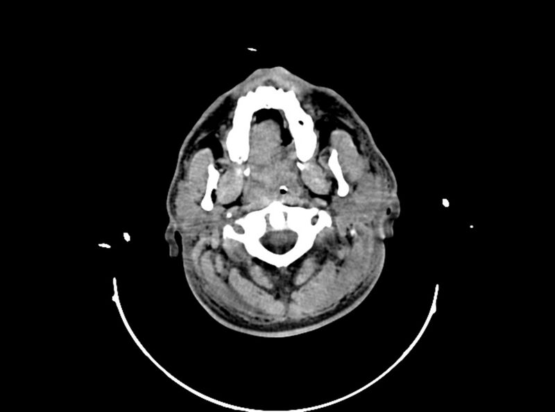 File:Brain injury by firearm projectile (Radiopaedia 82068-96087 B 29).jpg