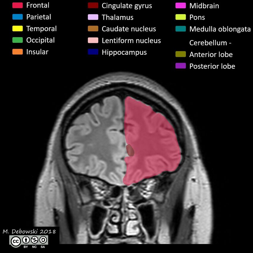 Brain lobes - annotated MRI (Radiopaedia 61691-69700 Coronal 15).JPG