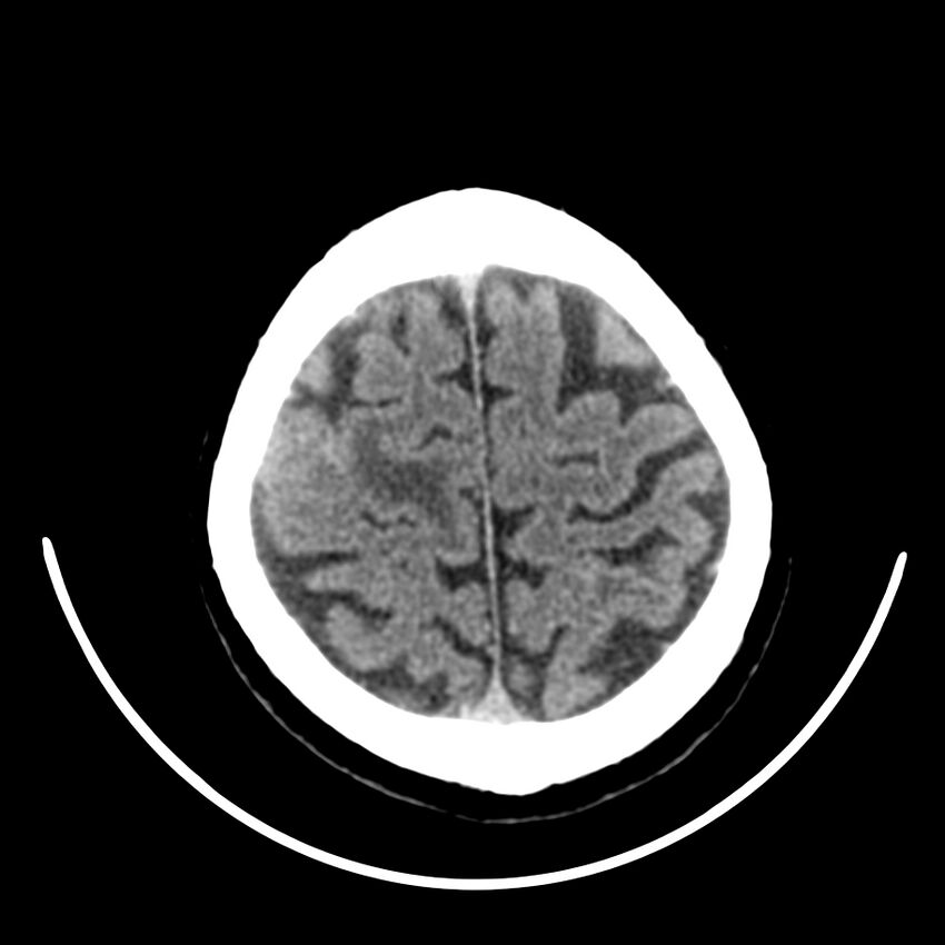 Brain metastasis (Radiopaedia 42617-45760 Axial non-contrast 43).jpg