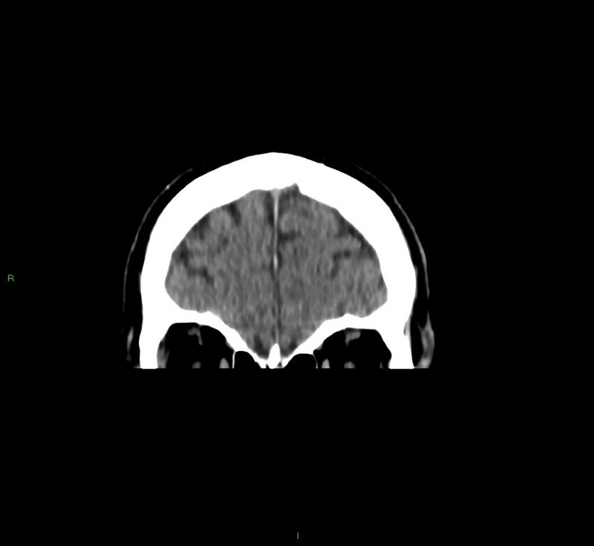 Brainstem hemorrhage (Radiopaedia 58794-66028 Coronal non-contrast 55).jpg