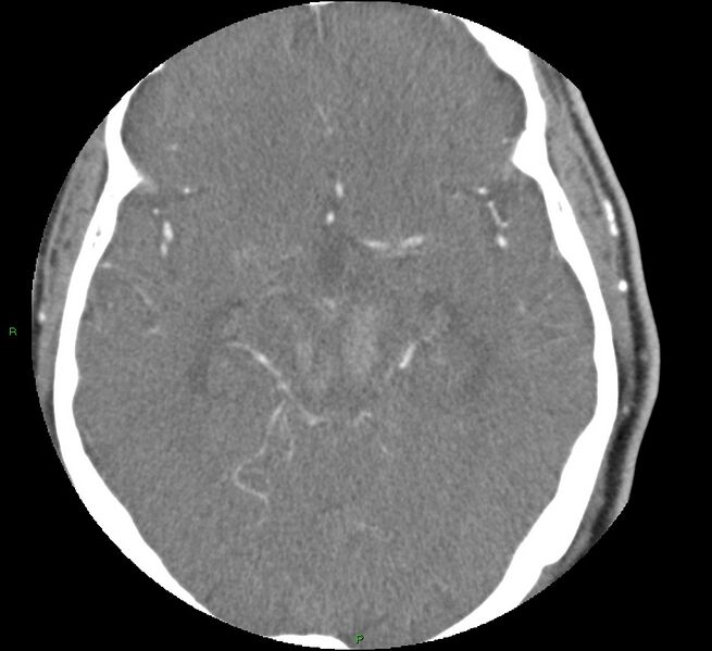 File:Brainstem hemorrhage (Radiopaedia 58794-66028 D 83).jpg