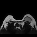 Breast implants - MRI (Radiopaedia 26864-27035 Axial T2 38).jpg