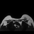 Breast implants - MRI (Radiopaedia 26864-27035 Axial T2 42).jpg