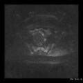 Broad ligament fibroid (Radiopaedia 49135-54241 Axial DWI 15).jpg