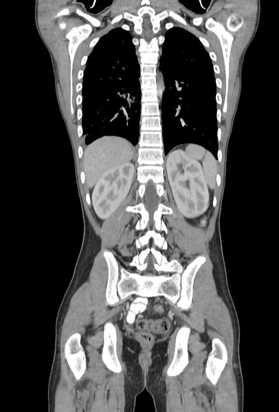 File:Bronchial carcinoid tumor (Radiopaedia 57187-64090 B 89).jpg