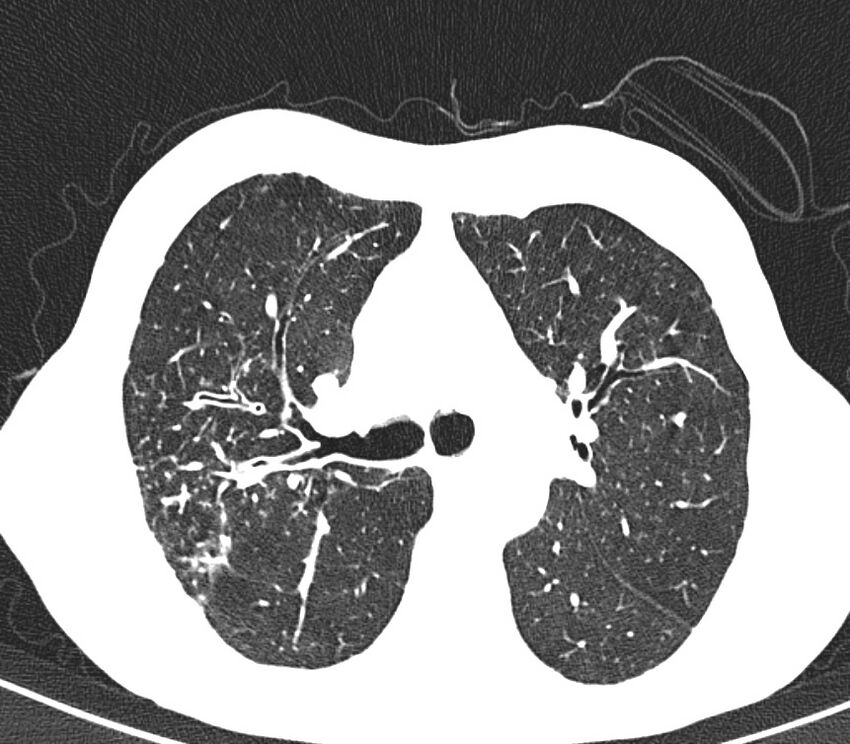 Bronchiolitis (Radiopaedia 24616-24887 Axial lung window 20).jpg