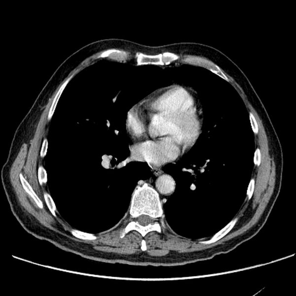 File:Bronchogenic carcinoma with L1 vertebra metastasis (Radiopaedia 9096-9805 Axial C+ delayed 20).jpg