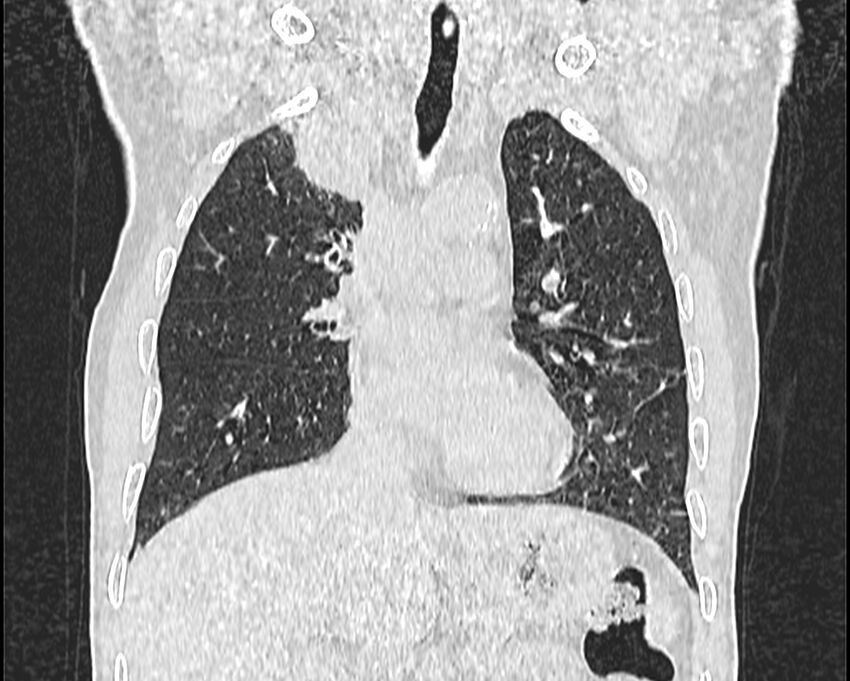 Bronchogenic carcinoma with superior vena cava syndrome (Radiopaedia 36497-38054 Coronal lung window 24).jpg