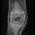 Bucket handle tear - lateral meniscus (Radiopaedia 72124-82634 Coronal PD fat sat 8).jpg