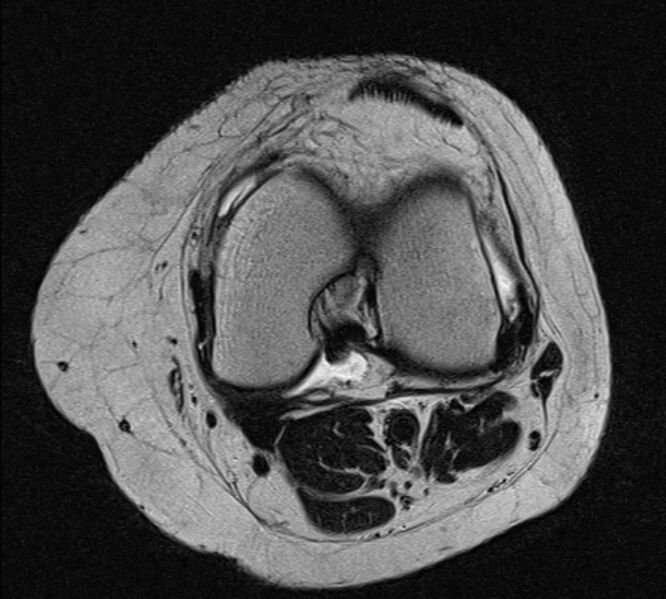 File:Bucket handle tear - medial meniscus (Radiopaedia 79028-91942 Axial T2 13).jpg