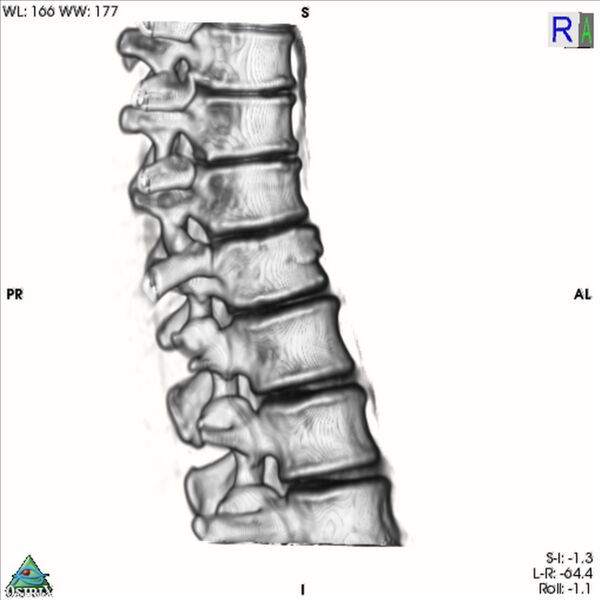 File:Bulging of paraspinal line in traumatic thoracal spinal compression fracture (Radiopaedia 29221-35872 3D VR 2).jpg