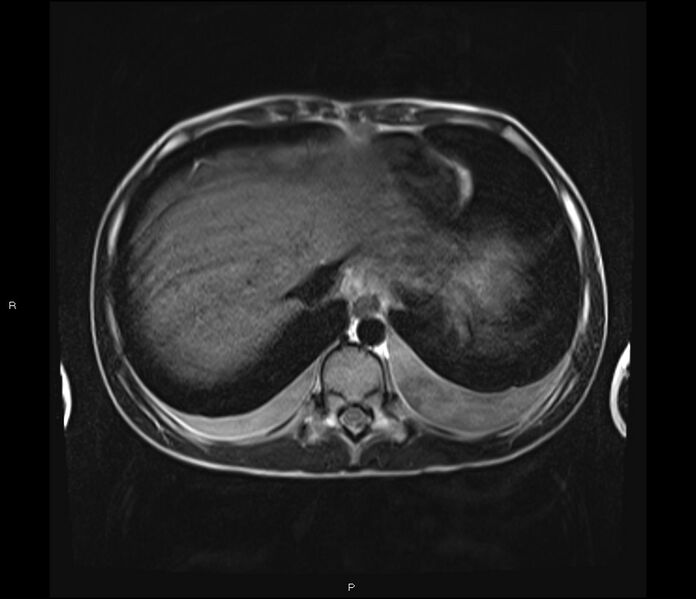 File:Burkitt lymphoma (bowel) (Radiopaedia 68839-78557 Axial T2 8).jpg