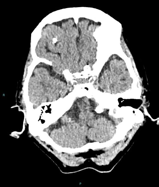 File:Calcified cerebral emboli from left ventricular thrombus (Radiopaedia 84420-99758 Axial non-contrast 73).jpg